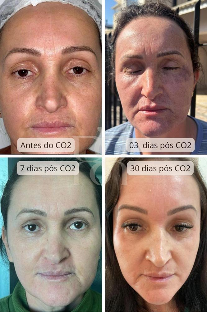 Laser CO2 para Estimular o Colágeno