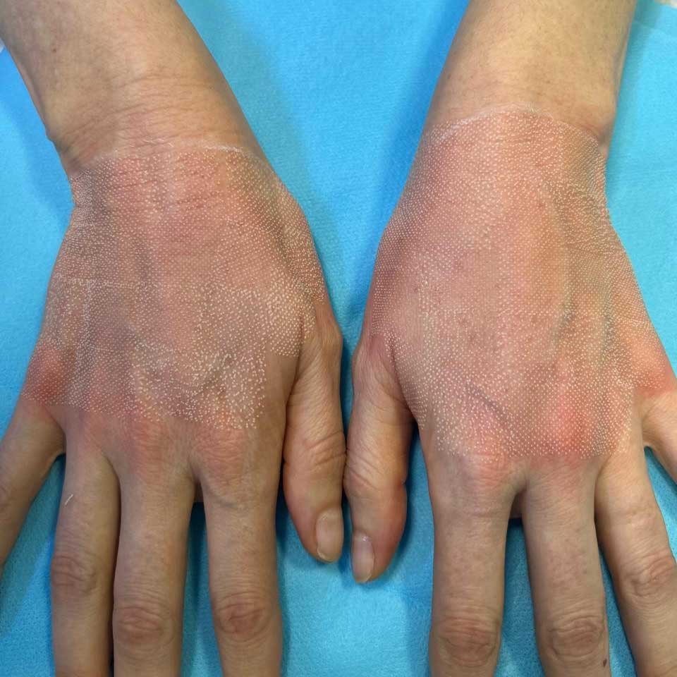 Laser CO2 para Estimular o Colágeno