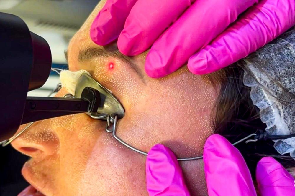 Laser CO2 para Estimular o Colágeno