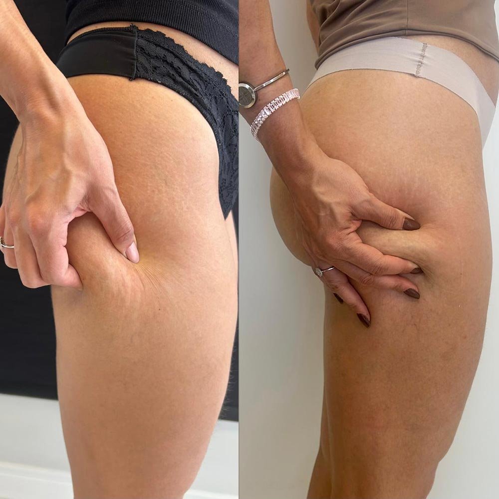 HIPRO para Lifting Facial e Corporal (Flacidez e Gordura Localizada)Desanexar