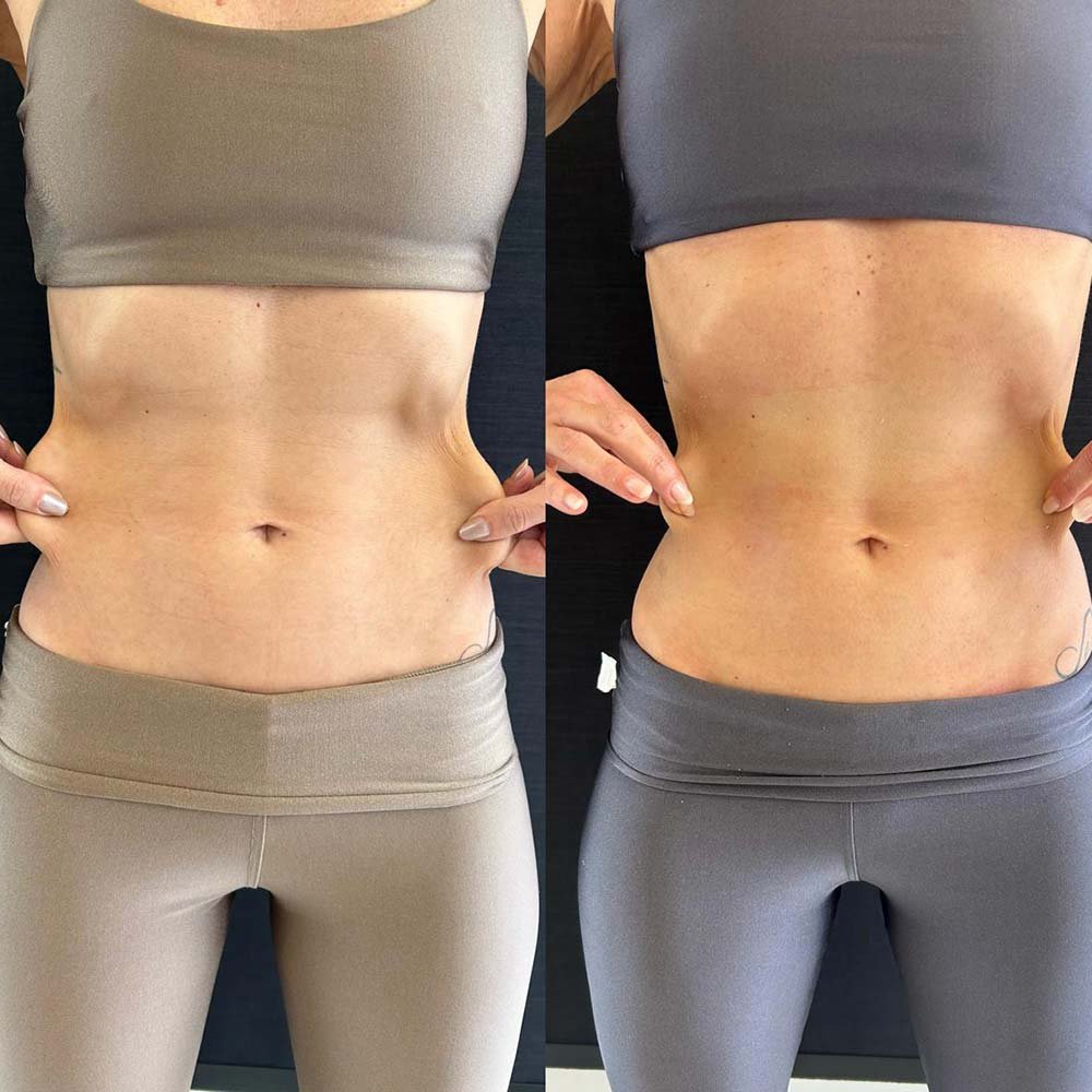 HIPRO para Lifting Facial e Corporal (Flacidez e Gordura Localizada)Desanexar