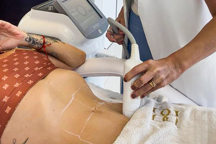 Lifting Facial e Corporal (Flacidez e Gordura Localizada) Para estimular colágeno, redefinir o contorno facial, suavizar papada e melhorar a firmeza da pele.